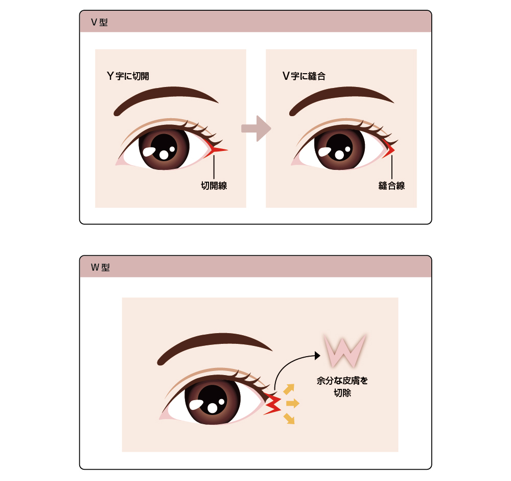 目尻切開ならボンボンクリニック 銀座駅前本院・渋谷院