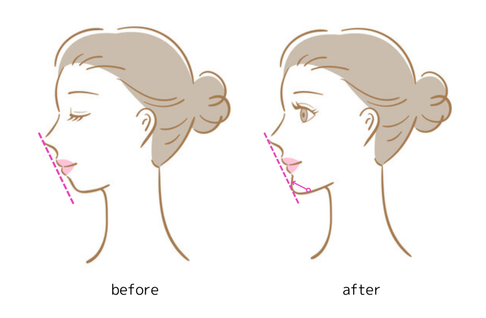 顎先リフトならボンボンクリニック 銀座駅前本院・渋谷院