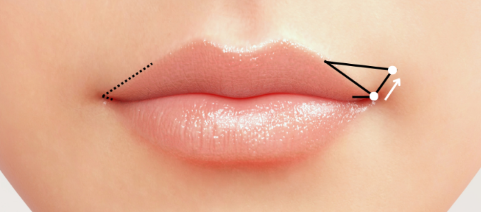 口角挙上術の解説図